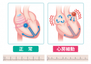 心房細動